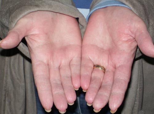 Diabetes and Hyperbaric Oxygen